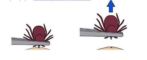 It is not difficult to remove a tick Do not use heat or apply oil butter or solvents Just grip it close to the skin with tweezers and apply firm steady tension straight out and it will release in a few seconds